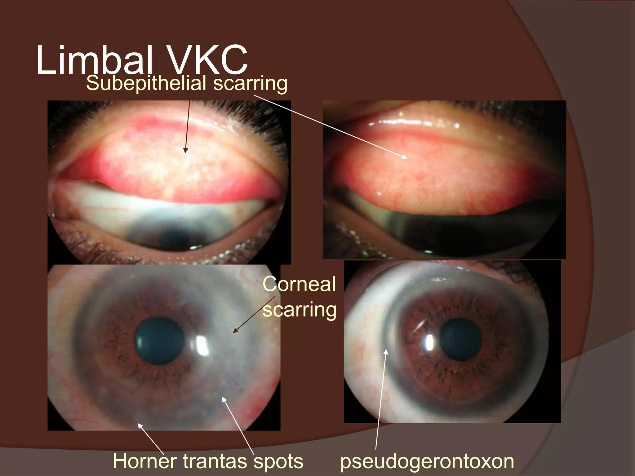 Limbal VKC
Horner trantas spots pseudogerontoxon
Subepithelial scarring
Corneal
scarring
 