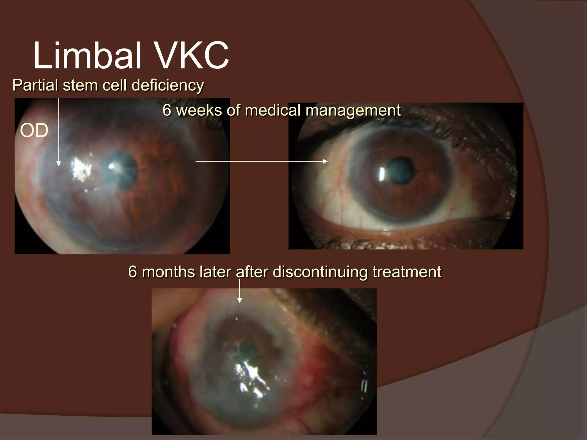 Limbal VKC
6 weeks of medical management
6 months later after discontinuing treatment
Partial stem cell deficiency
OD
 