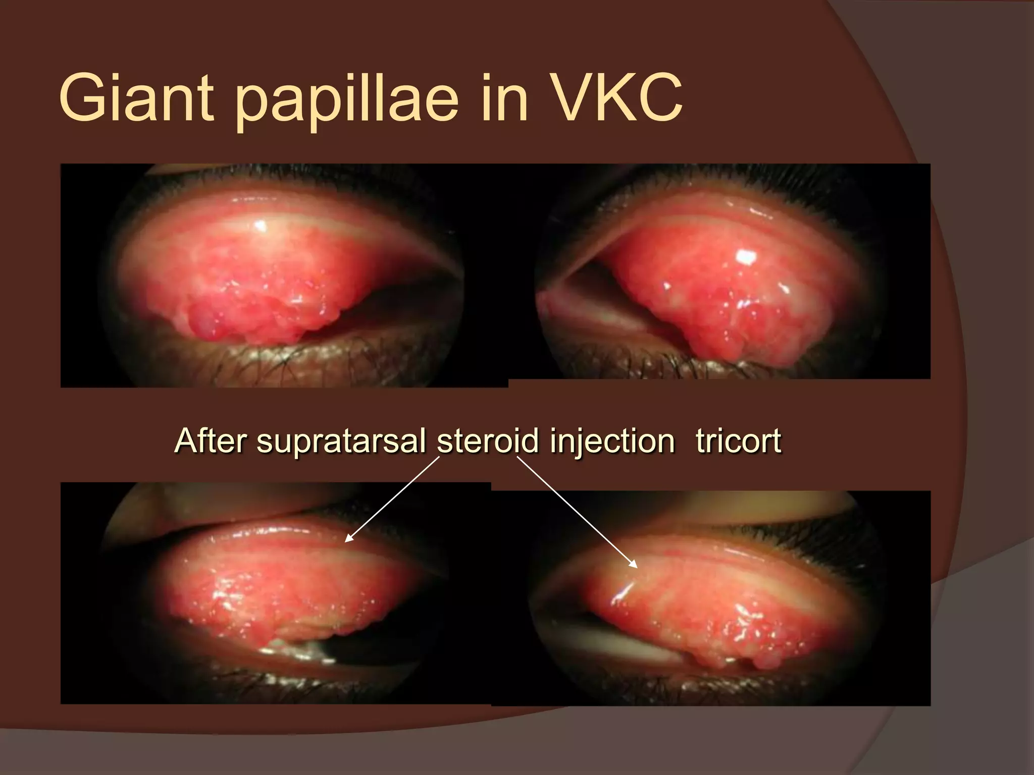 Giant papillae in VKC
After supratarsal steroid injection tricort
 