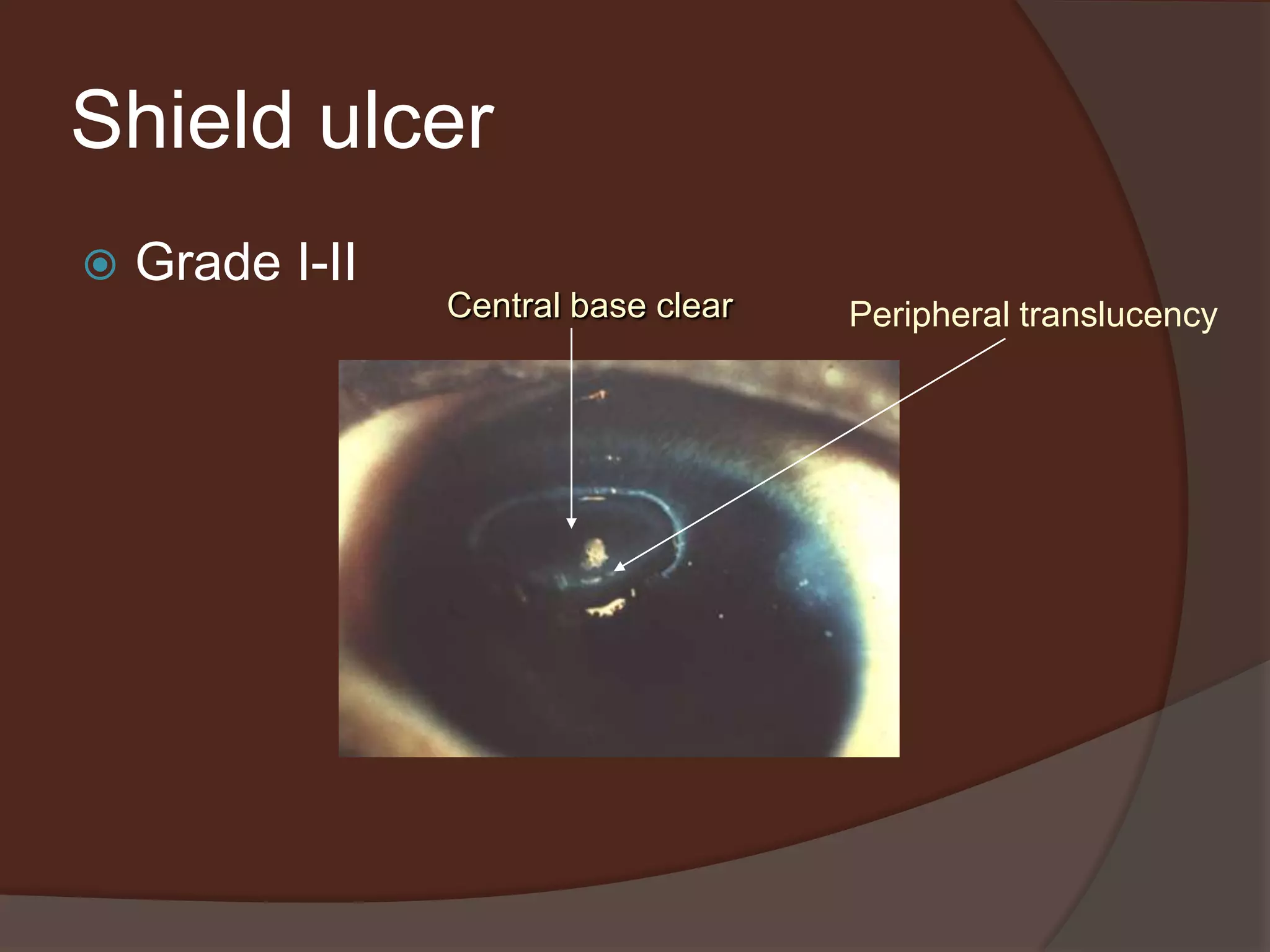 Shield ulcer
 Grade I-II
Central base clear Peripheral translucency
 