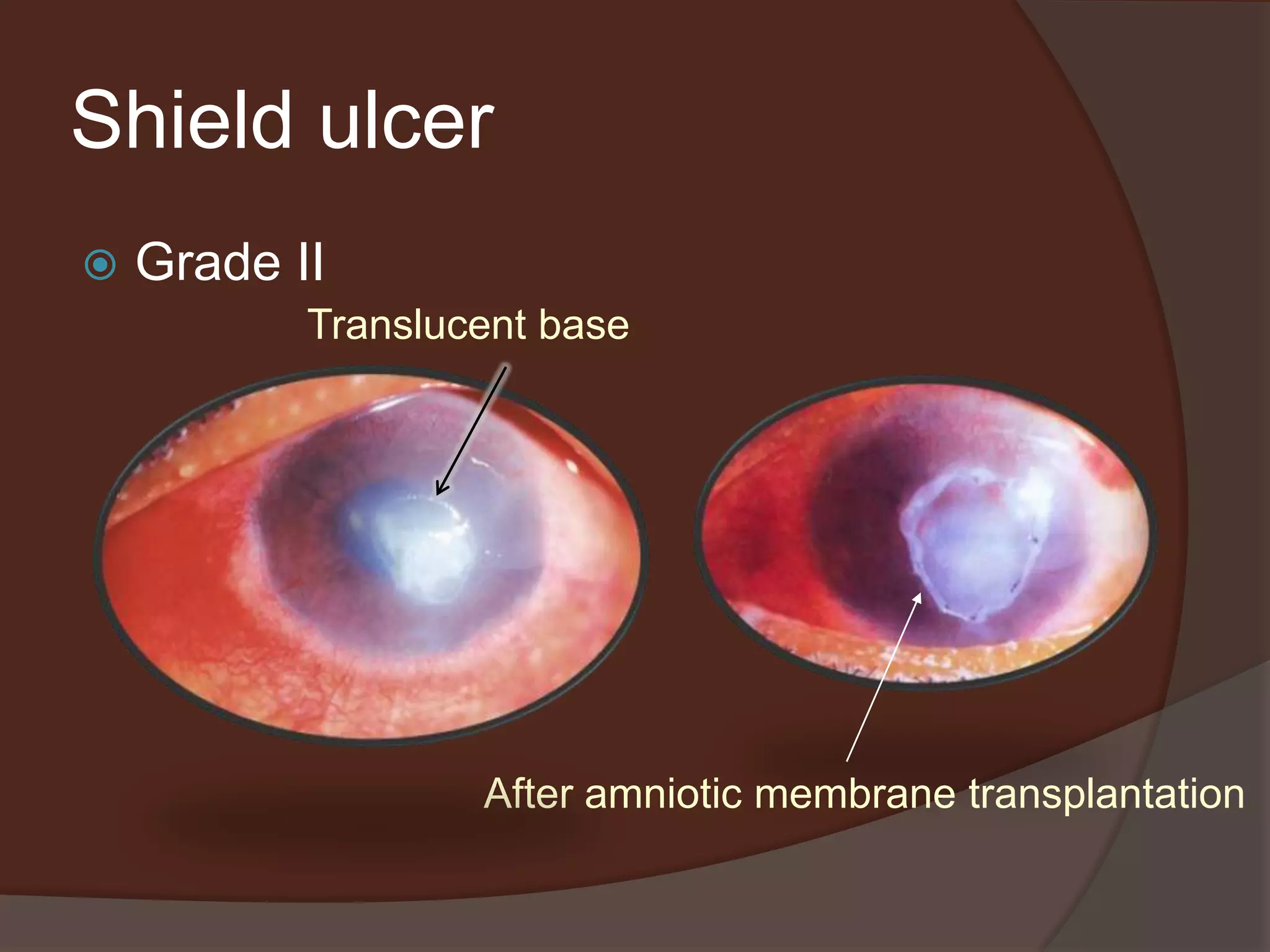 Shield ulcer
 Grade II
After amniotic membrane transplantation
Translucent base
 