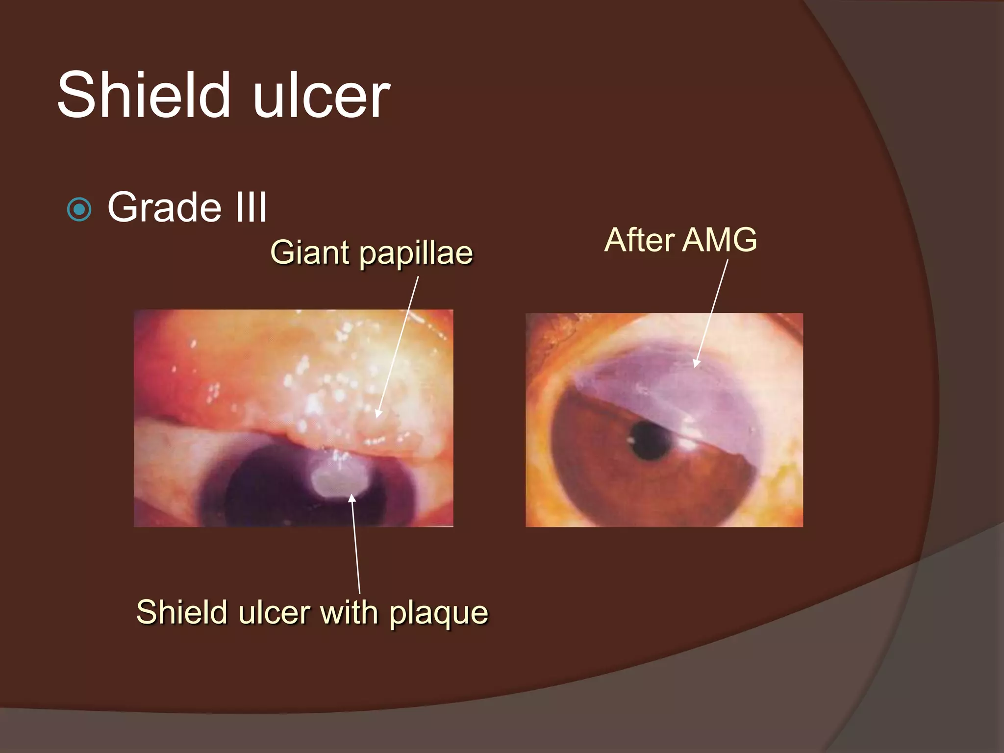 Shield ulcer
 Grade III
Giant papillae
Shield ulcer with plaque
After AMG
 