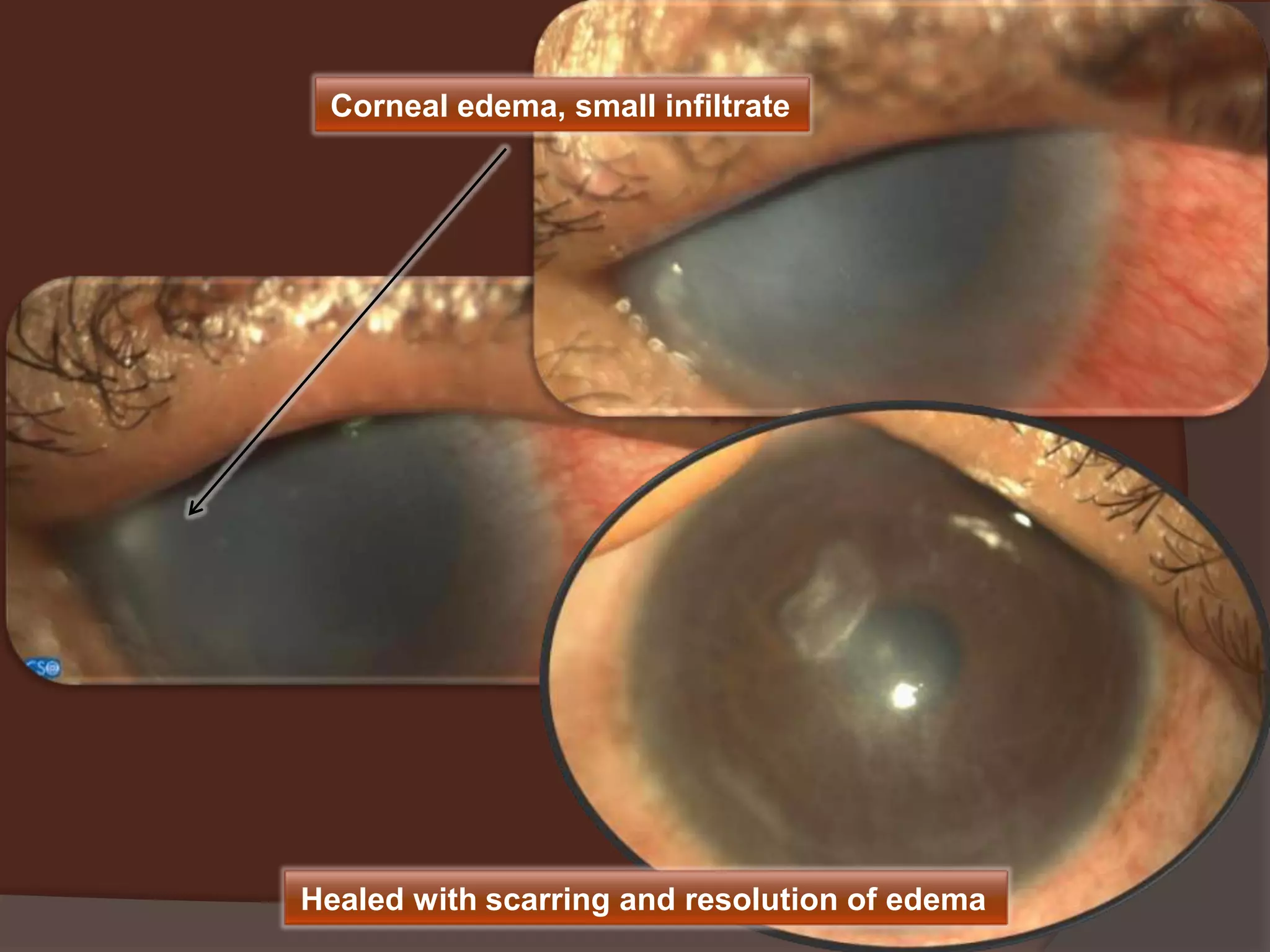 Corneal edema, small infiltrate
Healed with scarring and resolution of edema
 