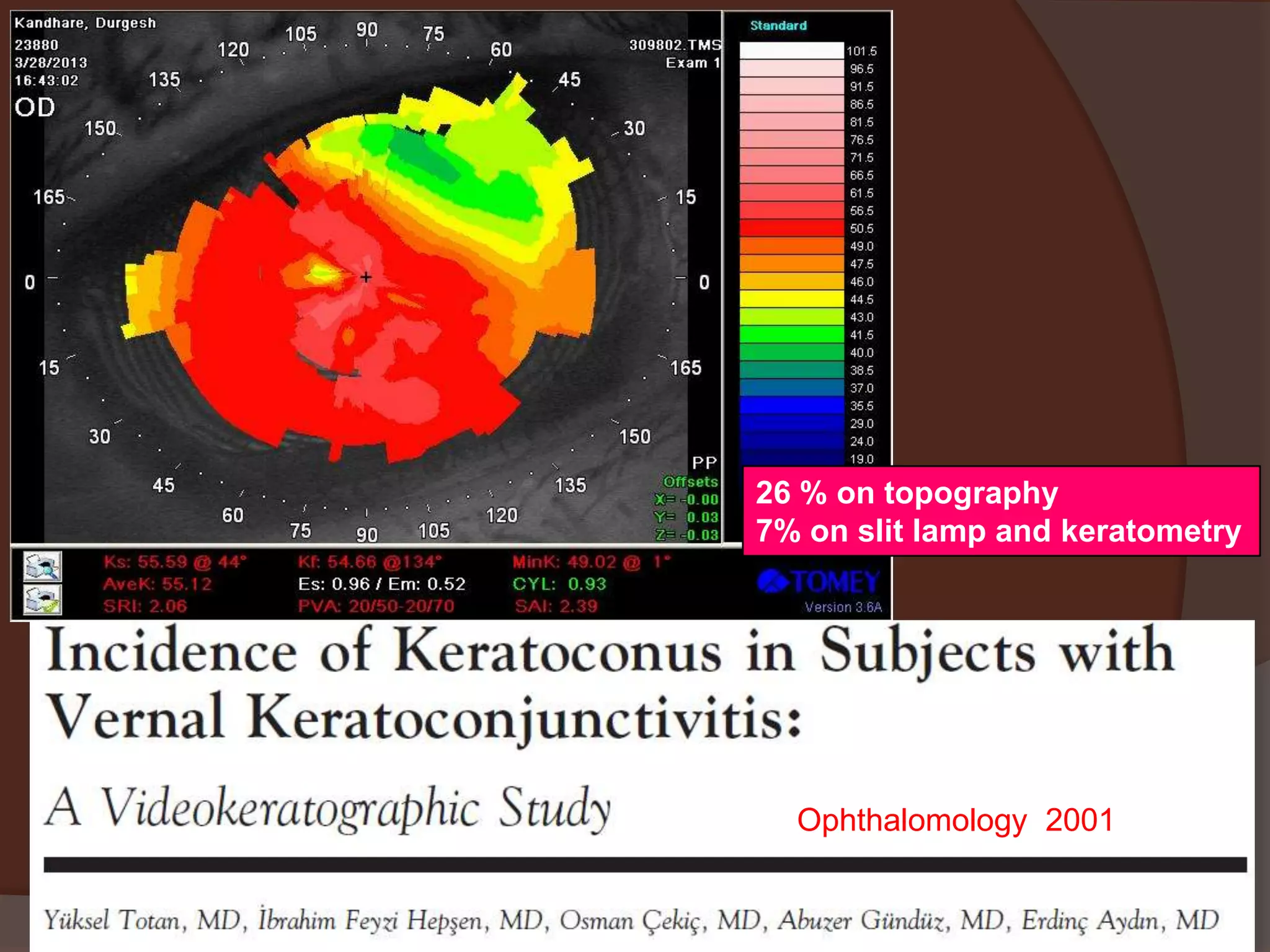 26 % on topography
7% on slit lamp and keratometry
Ophthalomology 2001
 
