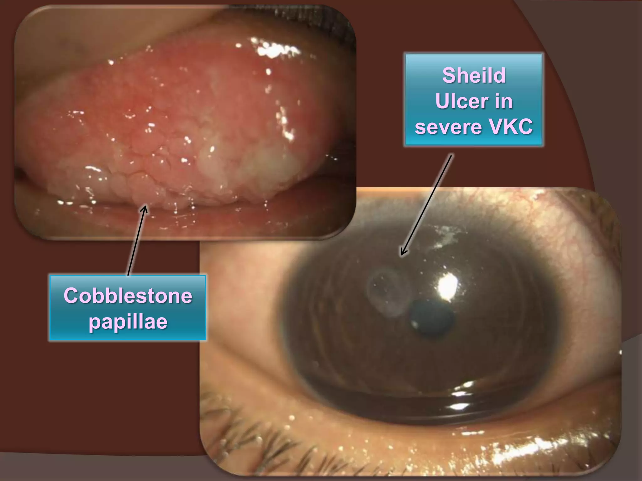 Sheild
Ulcer in
severe VKC
Cobblestone
papillae
 