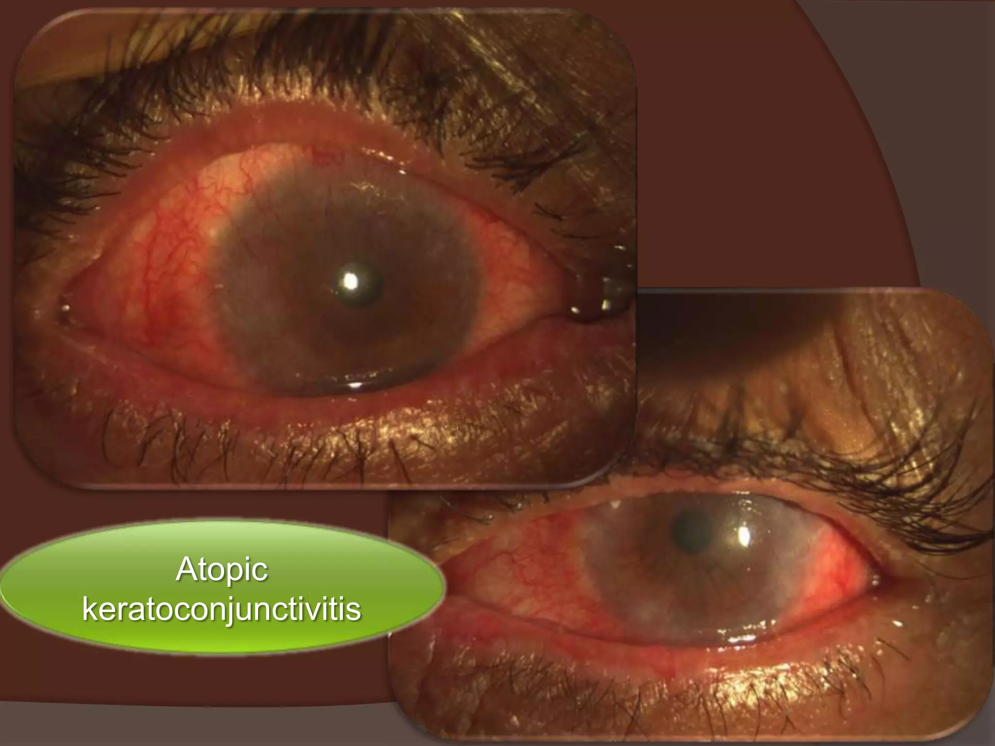 Atopic
keratoconjunctivitis
 