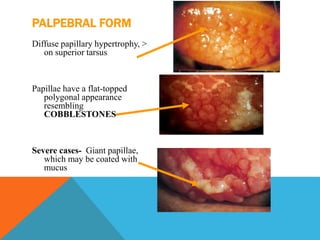 PALPEBRAL FORM
Diffuse papillary hypertrophy, >
on superior tarsus
Papillae have a flat-topped
polygonal appearance
resembling
COBBLESTONES
Severe cases- Giant papillae,
which may be coated with
mucus
 