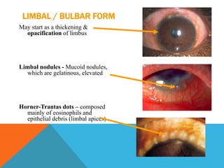 LIMBAL / BULBAR FORM
May start as a thickening &
opacification of limbus
Limbal nodules - Mucoid nodules,
which are gelatinous, elevated
Horner-Trantas dots – composed
mainly of eosinophils and
epithelial debris (limbal apices)
 