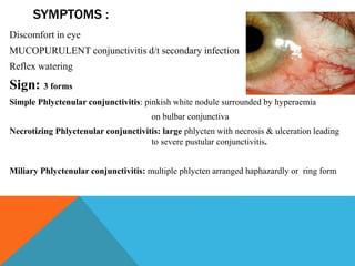 SYMPTOMS :
Discomfort in eye
MUCOPURULENT conjunctivitis d/t secondary infection
Reflex watering
Sign: 3 forms
Simple Phlyctenular conjunctivitis: pinkish white nodule surrounded by hyperaemia
on bulbar conjunctiva
Necrotizing Phlyctenular conjunctivitis: large phlycten with necrosis & ulceration leading
to severe pustular conjunctivitis.
Miliary Phlyctenular conjunctivitis: multiple phlycten arranged haphazardly or ring form
 