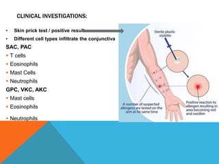 CLINICAL INVESTIGATIONS:
• Skin prick test / positive result
• Different cell types infiltrate the conjunctiva
SAC, PAC
 T cells
 Eosinophils
 Mast Cells
 Neutrophils
GPC, VKC, AKC
 Mast cells
 Eosinophils
 Neutrophils
 