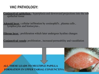 VKC PATHOLOGY:
Conjunctival epithelium : hyperplasia and downward projections into the sub
epithelial tissue
Adenoid layer : cellular infiltration by eosinophil's , plasma cells ,
lymphocytes and histiocytes .
Fibrous layer : proliferation which later undergoes hyaline changes
Conjunctival vessels: proliferation , increased permeability and vasodilation
ALL THESE LEADS TO MULTIPLE PAPILLA
FORMATION IN UPPER TARSAL CONJUNCTIVA
 