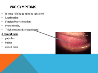 VKC SYMPTOMS
• Intense itching & burning sensation
• Lacrimation
• Foreign body sensation
• Photophobia,
• Thick mucous discharge [ropy]
3 clinical form
• palpebral
• bulbar
• mixed form
 