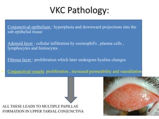 VKC Pathology:
• Conjunctival epithelium : hyperplasia and downward projections into the
sub epithelial tissue
• Adenoid layer : cellular infiltration by eosinophil's , plasma cells ,
lymphocytes and histiocytes .
• Fibrous layer : proliferation which later undergoes hyaline changes
• Conjunctival vessels: proliferation , increased permeability and vasodilation
ALL THESE LEADS TO MULTIPLE PAPILLAE
FORMATION IN UPPER TARSAL CONJUNCTIVA
 
