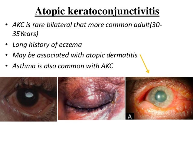 allergic conjunctivitis cold compress allergic conjunctivitis cold compress