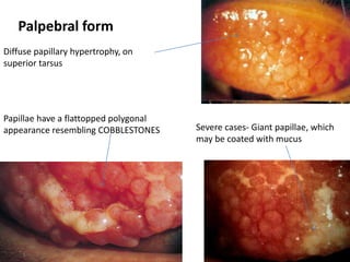 Diffuse papillary hypertrophy, on
superior tarsus
Papillae have a flattopped polygonal
appearance resembling COBBLESTONES
Palpebral form
Severe cases- Giant papillae, which
may be coated with mucus
 