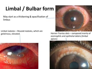 Limbal / Bulbar form
May start as a thickening & opacification of
limbus
Limbal nodules – Mucoid nodules, which are
gelatinous, elevated. Horner-Trantas dots – composed mainly of
eosinophils and epithelial debris (limbal
apices)
 