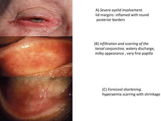 A) Severe eyelid involvement.
lid margins: inflamed with round
posterior borders
(B) infiltration and scarring of the
tarsal conjunctiva. watery discharge,
milky appearance , very fine papilla
(C) Forniceal shortening.
hyperaemia scarring with shrinkage
 