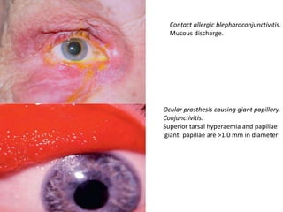 Contact allergic blepharoconjunctivitis.
Mucous discharge.
Ocular prosthesis causing giant papillary
Conjunctivitis.
Superior tarsal hyperaemia and papillae
‘giant’ papillae are >1.0 mm in diameter
 