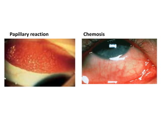 Papillary reaction Chemosis
 