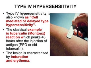Iv Induration Allergic diseases Ppt Lecture 2 BCM .ppt