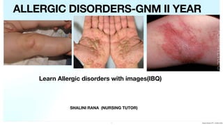 SHALINI RANA (NURSING TUTOR)
ALLERGIC DISORDERS-GNM II YEAR
Learn Allergic disorders with images(IBQ)
1 Allergic disorders PPT - 24 March 2024
 