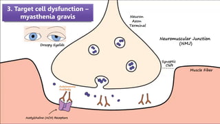 3. Target cell dysfunction –
myasthenia gravis
 