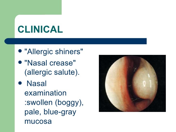 Allergic rhinitis