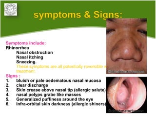 symptoms & Signs:

Symptoms include:
Rhinorrhea
    Nasal obstruction
    Nasal itching
    Sneezing.
    These symptoms are all potentially reversible with
    treatment.
Signs :
1.  bluish or pale oedematous nasal mucosa
2.  clear discharge
3.  Skin crease above nasal tip (allergic salute)
4.  nasal polyps grabe like masses
5.  Generalized puffiness around the eye
6.  Infra-orbital skin darkness (allergic shiners)
 