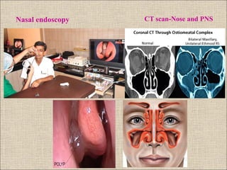 Allergic Rhinitis | PPT