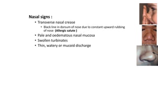 Allergic rhinitis symptoms signs treatment ent ppt | PPTX