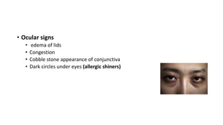 • Ocular signs 
• edema of lids 
• Congestion 
• Cobble stone appearance of conjunctiva 
• Dark circles under eyes (allergic shiners) 
 
