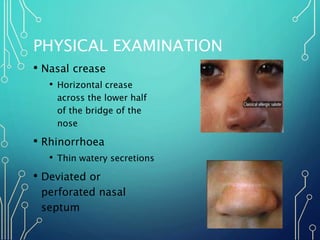 PHYSICAL EXAMINATION
• Nasal crease
• Horizontal crease
across the lower half
of the bridge of the
nose
• Rhinorrhoea
• Th...