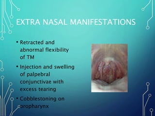EXTRA NASAL MANIFESTATIONS
• Retracted and
abnormal flexibility
of TM
• Injection and swelling
of palpebral
conjunctivae w...