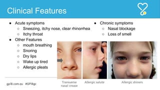 Allergic rhinitis | PPTX