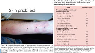 Skin prick Test
 
