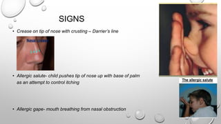 SIGNS
• Crease on tip of nose with crusting – Darrier’s line
• Allergic salute- child pushes tip of nose up with base of palm
as an attempt to control itching
• Allergic gape- mouth breathing from nasal obstruction
 