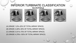 INFERIOR TURBINATE CLASSIFICATION
SYSTEM
(A) GRADE 1 (0%–25% OF TOTAL AIRWAY SPACE)
(B) GRADE 2 (26%–50% OF TOTAL AIRWAY SPACE)
(C) GRADE 3 (51%–75% OF TOTAL AIRWAY SPACE)
(D) GRADE 4 (76%–100% OF TOTAL AIRWAY SPACE)
 