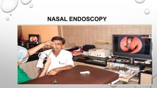 NASAL ENDOSCOPY
 