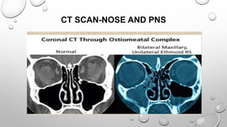 CT SCAN-NOSE AND PNS
 