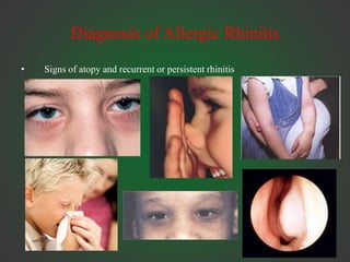 Diagnosis of Allergic Rhinitis
• Signs of atopy and recurrent or persistent rhinitis
 