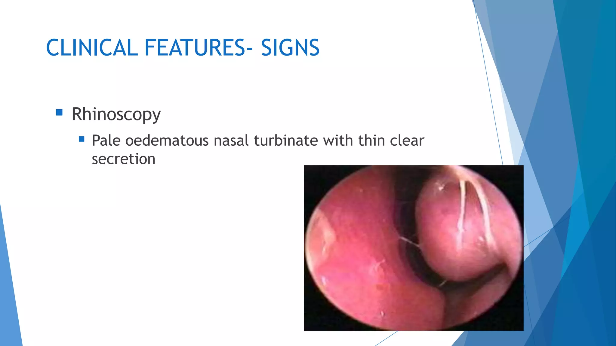Allergic Rhinitis.ppt