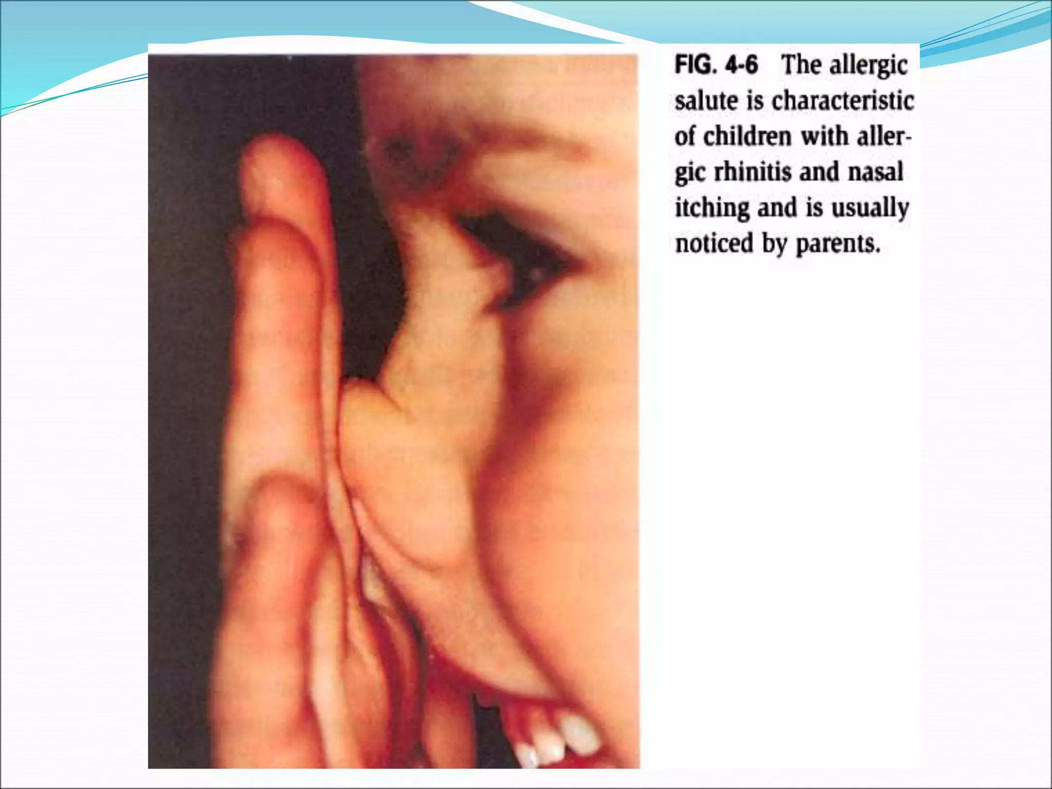 ALLERGIC RHINITIS.ppt
