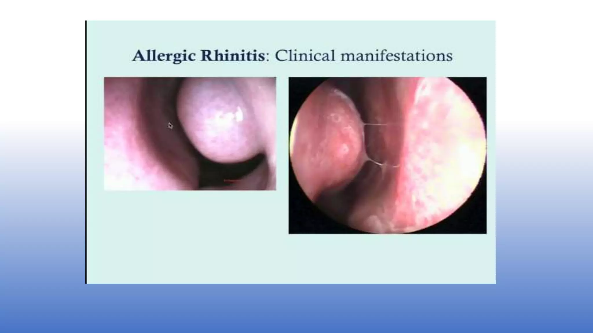 allergic rhinitis.pptx