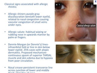 Classical signs associated with allergic
rhinitis:
• Allergic shiners-purple gray
discolouration beneath lower eyelid,
related to nasal congestion causing
vascular congestion of small veins
under eyes.
• Allergic salute- habitual wiping or
rubbing nose in upwards manner by
palm or fingers.
• Dennie-Morgan (or Dennie’s) lines-
infraorbital fold or line in skin below
lower eyelid. 25% cases with atopic
dermatitis. Proposed mechanism-
continuous spasm of superior TARSAL
muscle and skin edema due to hypoxia
from poor circulation.
• Nasal crease-persistent transverse line
across junction of lower and middle
 