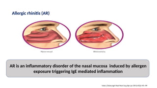 allergic rhinitis BASIC PRESENTATION.pptx