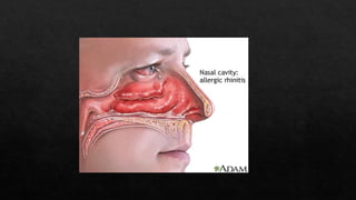 Comprehensive Clinical Overview of Allergic Rhinitis: Pathophysiology ...