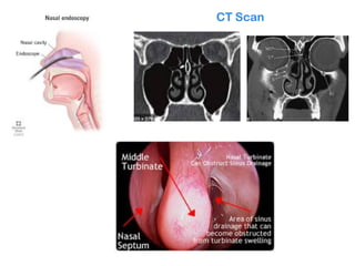 Comprehensive Overview of Allergic Rhinitis: Causes, Diagnosis, and ...
