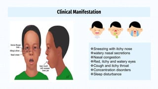 Allergic Rhinitis | PDF