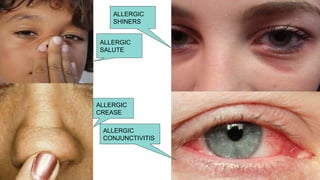 Comprehensive Overview of Allergic Rhinitis and Nasal Polyposis ...