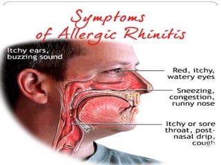 Allergic rhinitis powerpointt